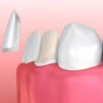 dental veneers