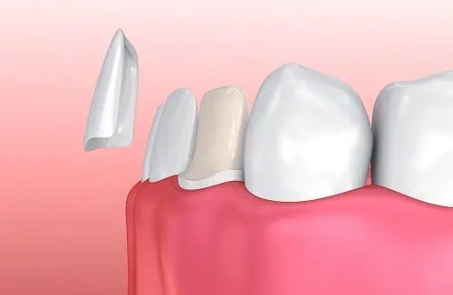 dental veneers