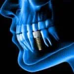 dental implant